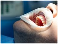 Benefits of tooth veneers (Image via Freepik/ Kamran Aydinov)